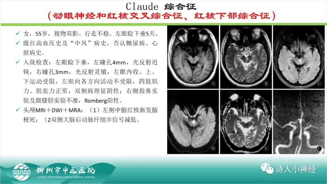 影像PPT - 【PPT】各种脑干梗死综合征临床解剖及影像-20