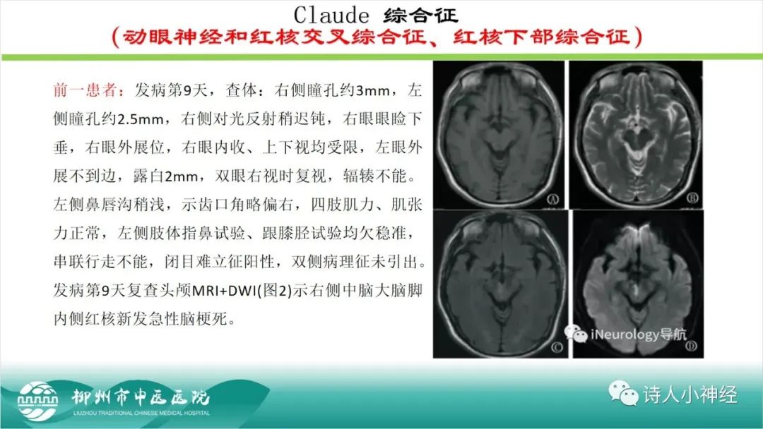 影像PPT - 【PPT】各种脑干梗死综合征临床解剖及影像-22