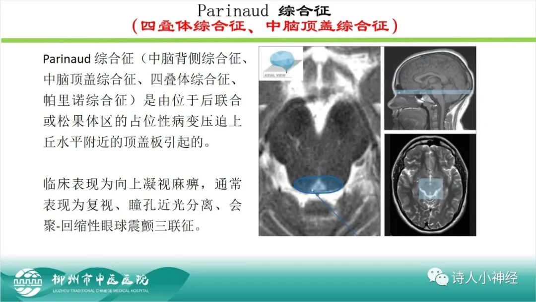 影像PPT - 【PPT】各种脑干梗死综合征临床解剖及影像-24
