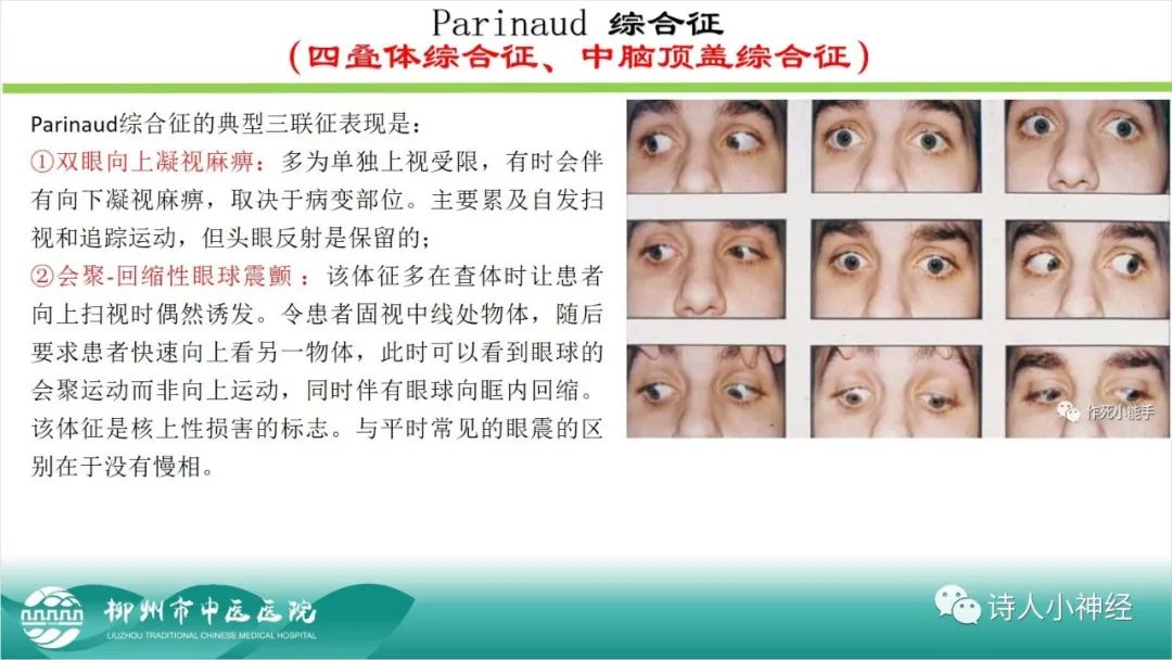 影像PPT - 【PPT】各种脑干梗死综合征临床解剖及影像-27