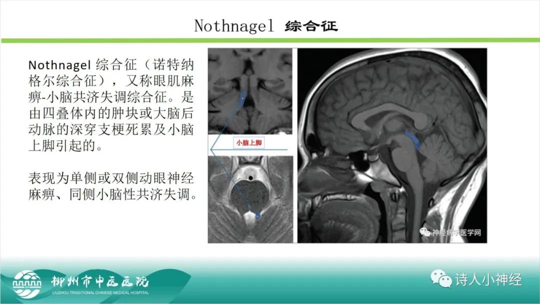 影像PPT - 【PPT】各种脑干梗死综合征临床解剖及影像-30