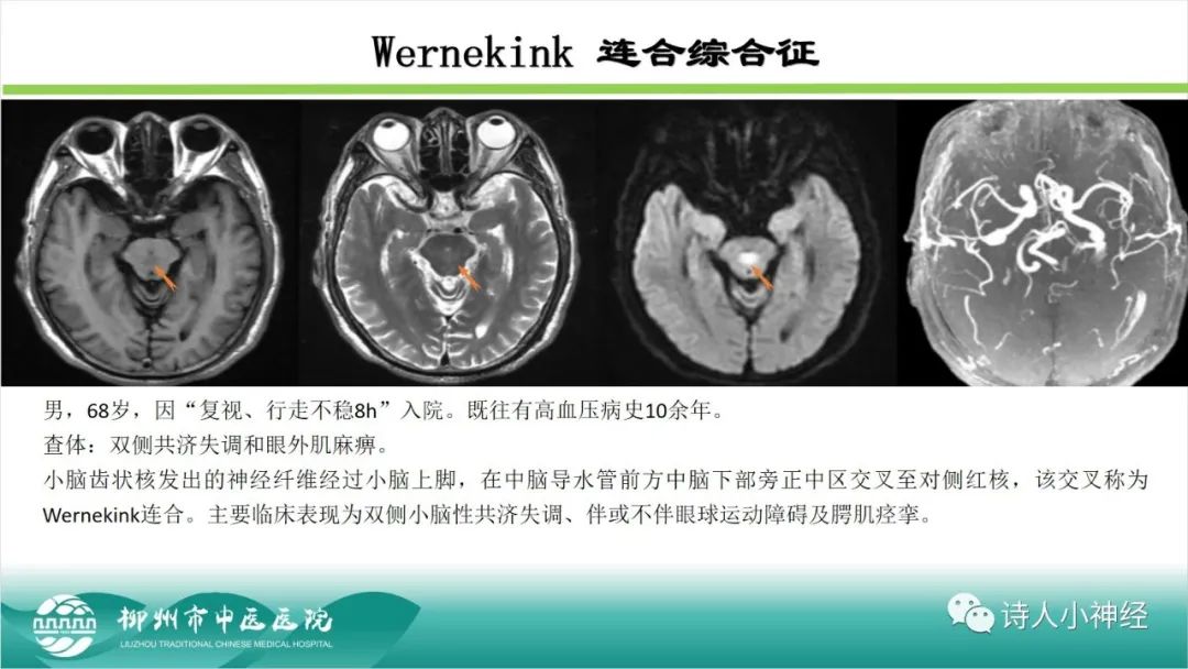 影像PPT - 【PPT】各种脑干梗死综合征临床解剖及影像-32
