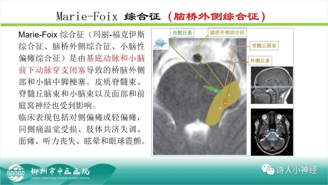 影像PPT - 【PPT】各种脑干梗死综合征临床解剖及影像-37