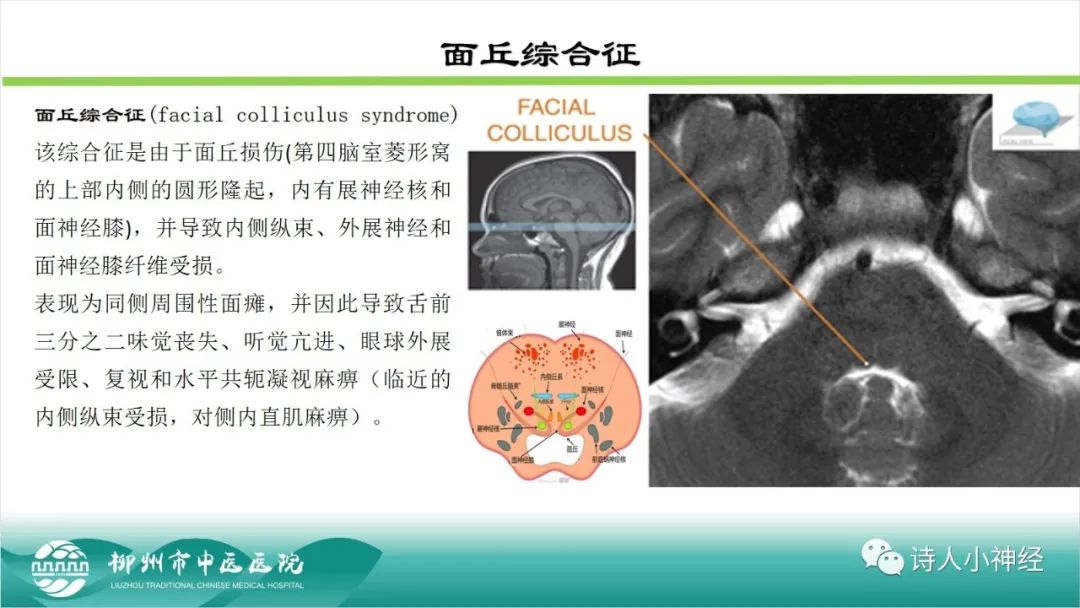 影像PPT - 【PPT】各种脑干梗死综合征临床解剖及影像-41