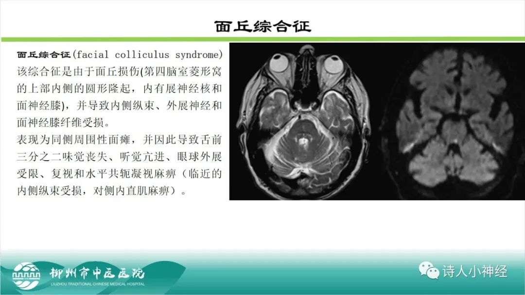 影像PPT - 【PPT】各种脑干梗死综合征临床解剖及影像-42