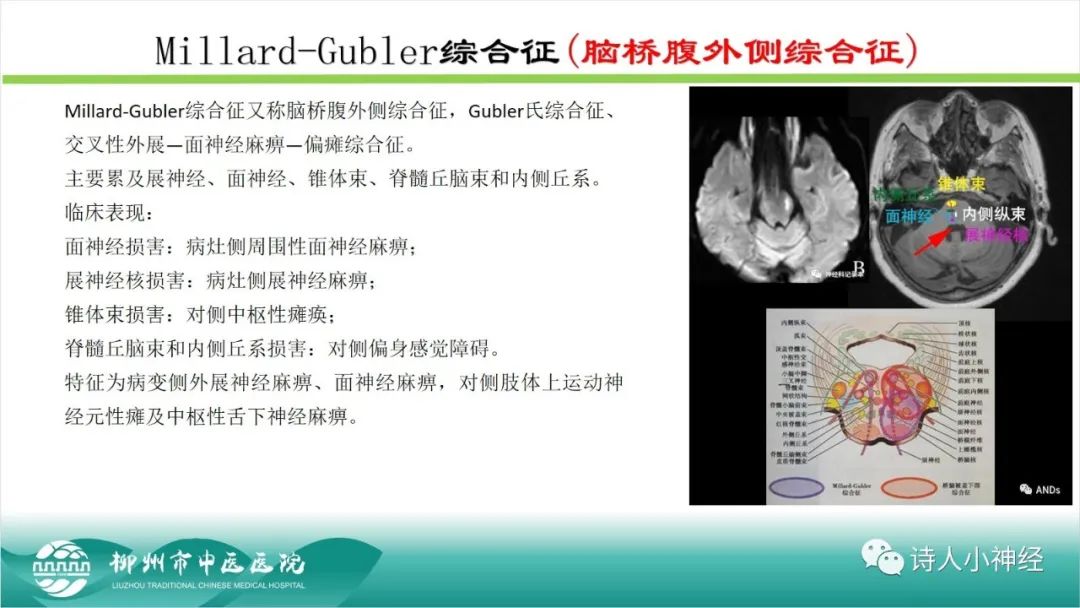 影像PPT - 【PPT】各种脑干梗死综合征临床解剖及影像-48