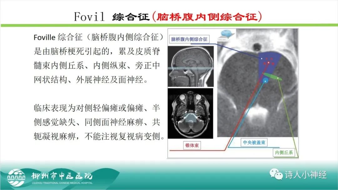 影像PPT - 【PPT】各种脑干梗死综合征临床解剖及影像-51