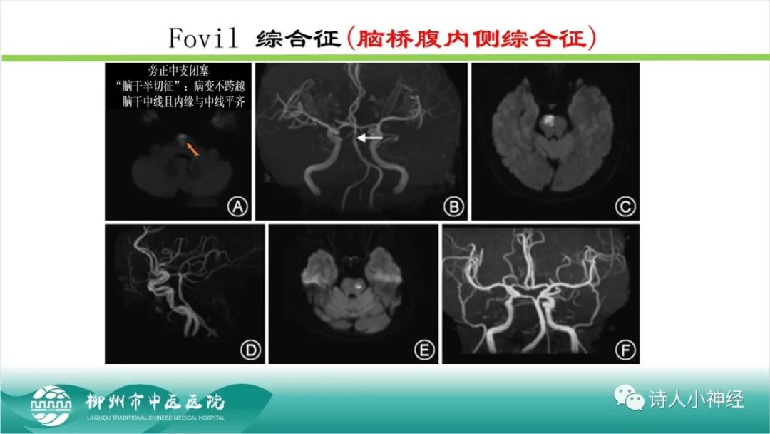 影像PPT - 【PPT】各种脑干梗死综合征临床解剖及影像-55
