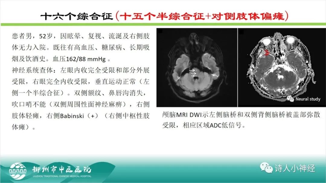 影像PPT - 【PPT】各种脑干梗死综合征临床解剖及影像-60