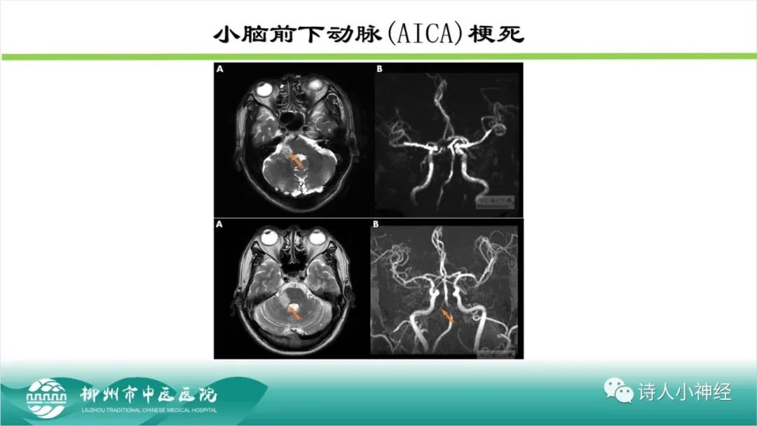 影像PPT - 【PPT】各种脑干梗死综合征临床解剖及影像-68