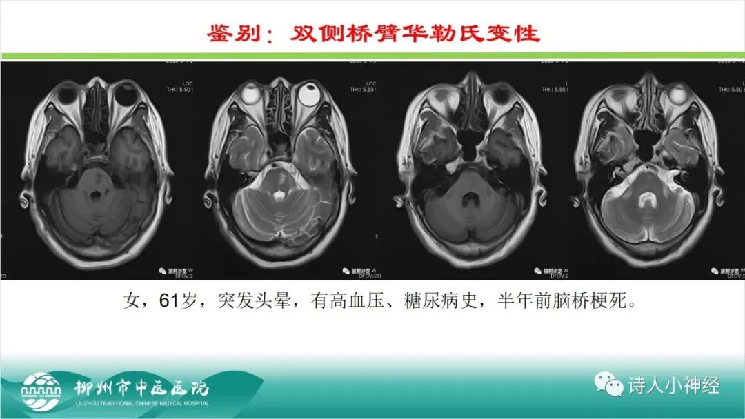 影像PPT - 【PPT】各种脑干梗死综合征临床解剖及影像-74