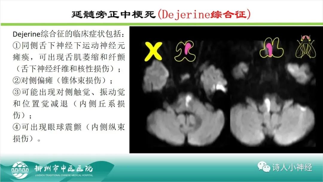 影像PPT - 【PPT】各种脑干梗死综合征临床解剖及影像-82