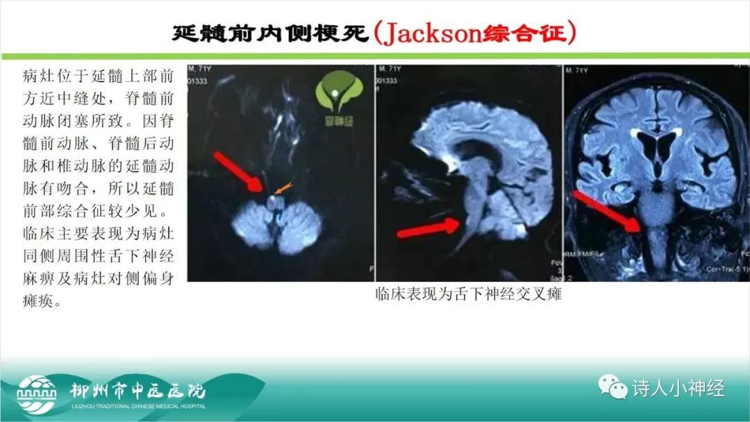 影像PPT - 【PPT】各种脑干梗死综合征临床解剖及影像-87
