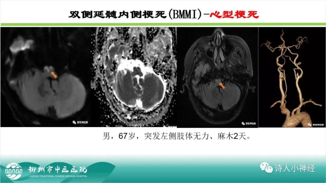 影像PPT - 【PPT】各种脑干梗死综合征临床解剖及影像-93