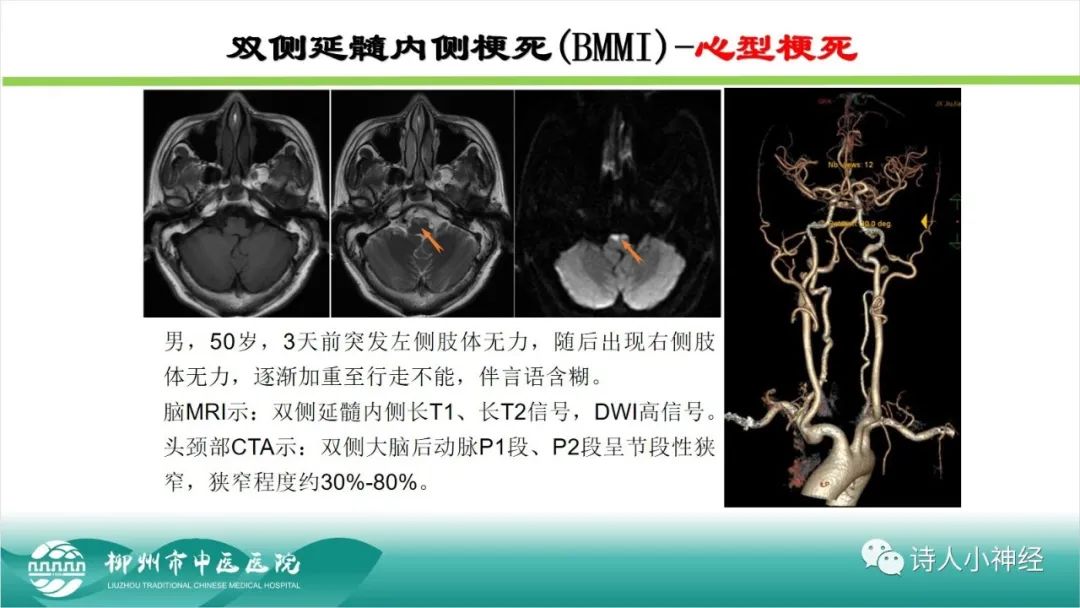 影像PPT - 【PPT】各种脑干梗死综合征临床解剖及影像-94