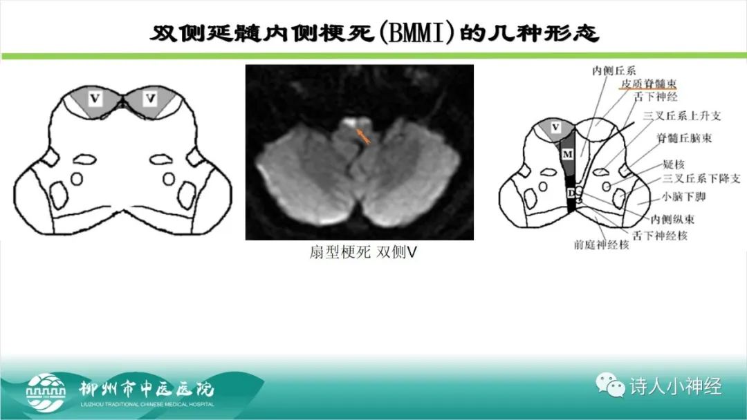 影像PPT - 【PPT】各种脑干梗死综合征临床解剖及影像-97