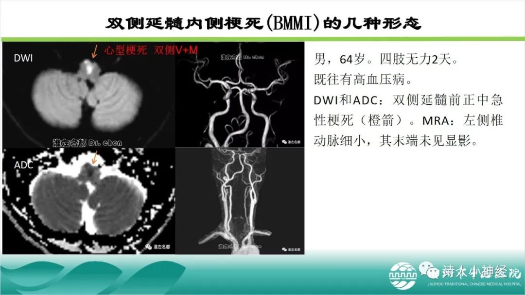 影像PPT - 【PPT】各种脑干梗死综合征临床解剖及影像-98