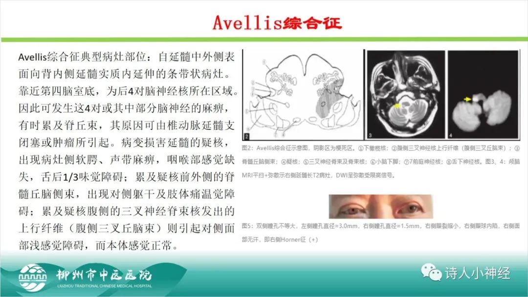 影像PPT - 【PPT】各种脑干梗死综合征临床解剖及影像-100