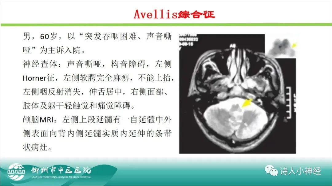 影像PPT - 【PPT】各种脑干梗死综合征临床解剖及影像-102