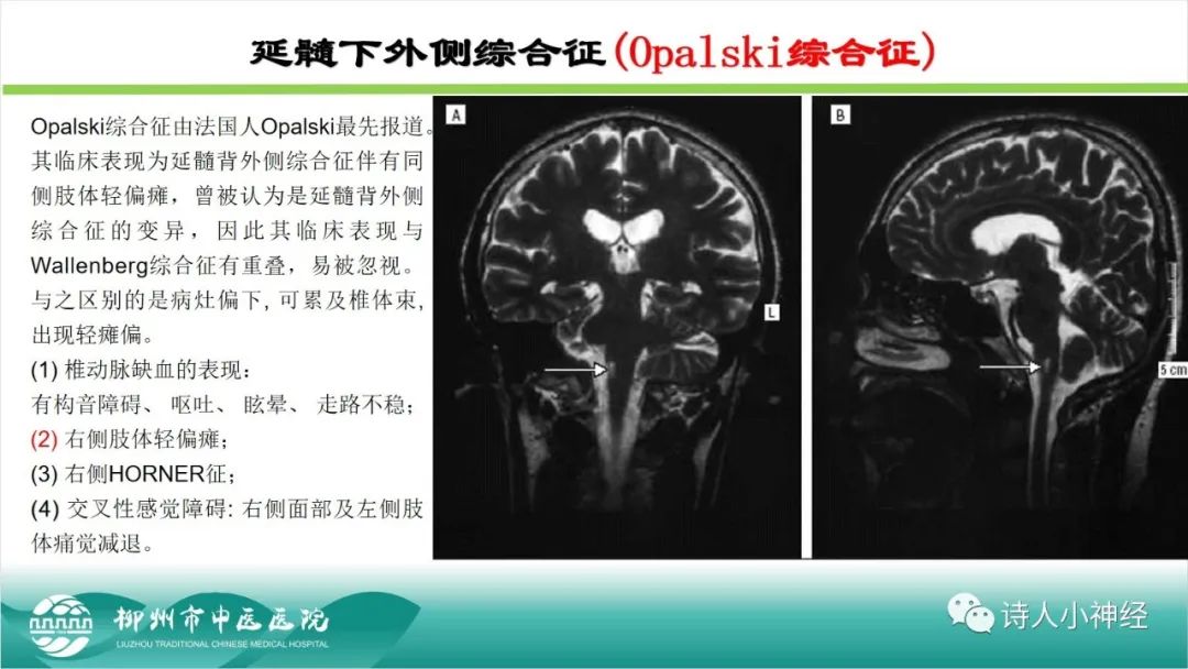 影像PPT - 【PPT】各种脑干梗死综合征临床解剖及影像-109