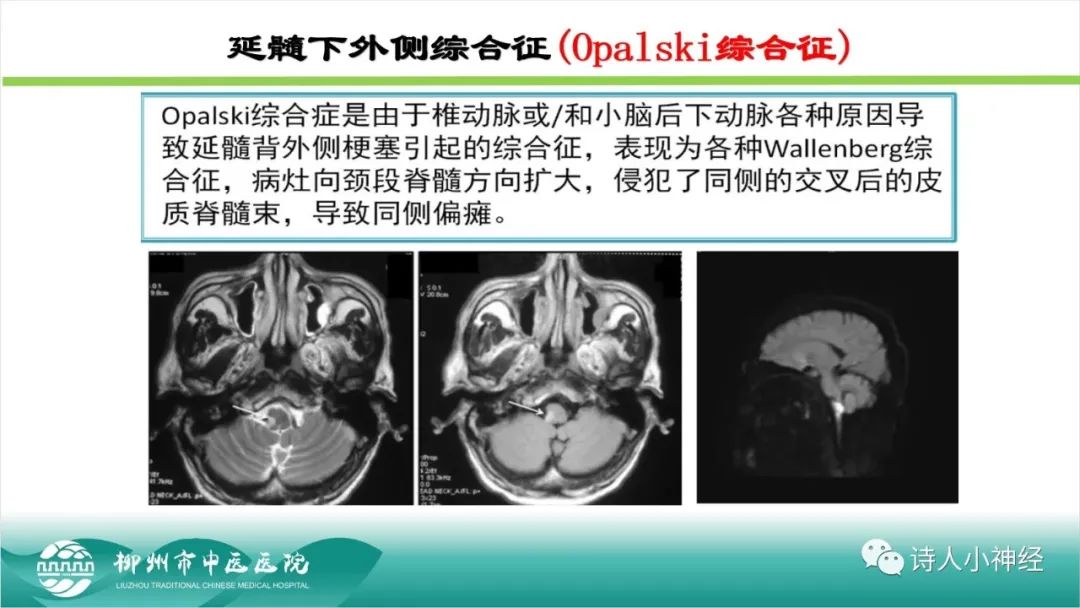 影像PPT - 【PPT】各种脑干梗死综合征临床解剖及影像-110