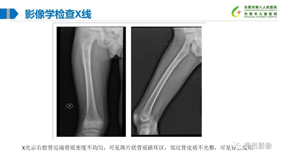 影像PPT - 【PPT】儿童骨淋巴瘤的影像表现-4