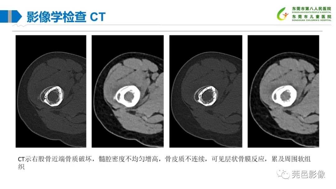 影像PPT - 【PPT】儿童骨淋巴瘤的影像表现-5