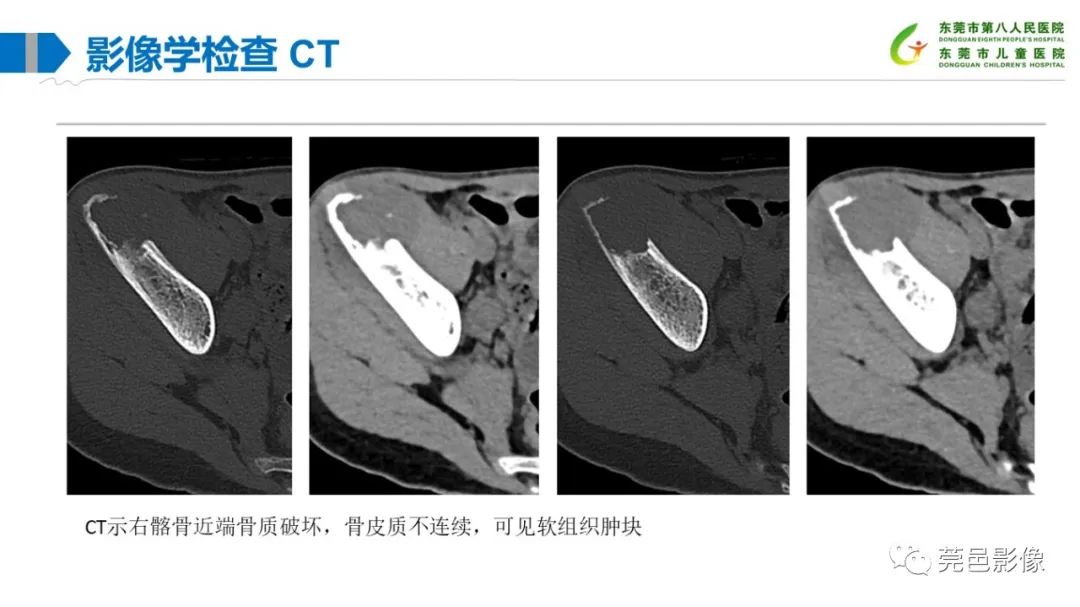 影像PPT - 【PPT】儿童骨淋巴瘤的影像表现-6