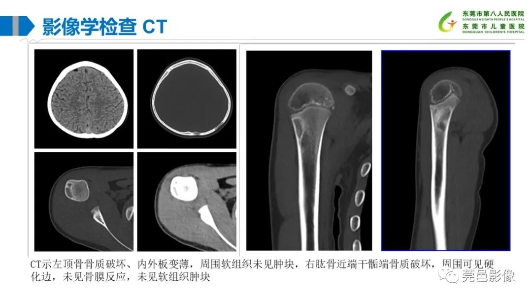 影像PPT - 【PPT】儿童骨淋巴瘤的影像表现-7