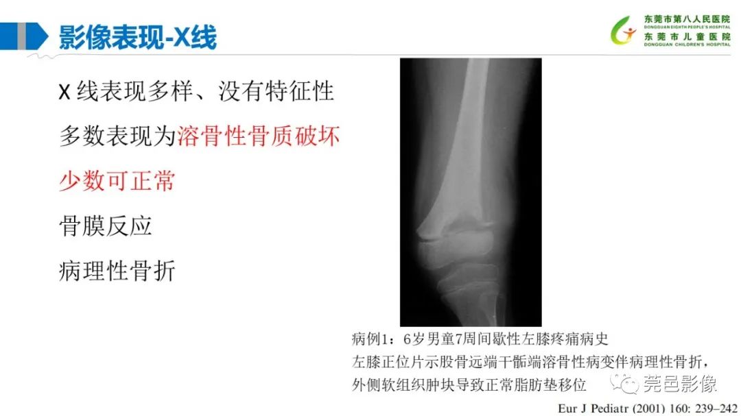 影像PPT - 【PPT】儿童骨淋巴瘤的影像表现-17
