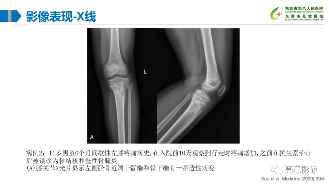 影像PPT - 【PPT】儿童骨淋巴瘤的影像表现-18