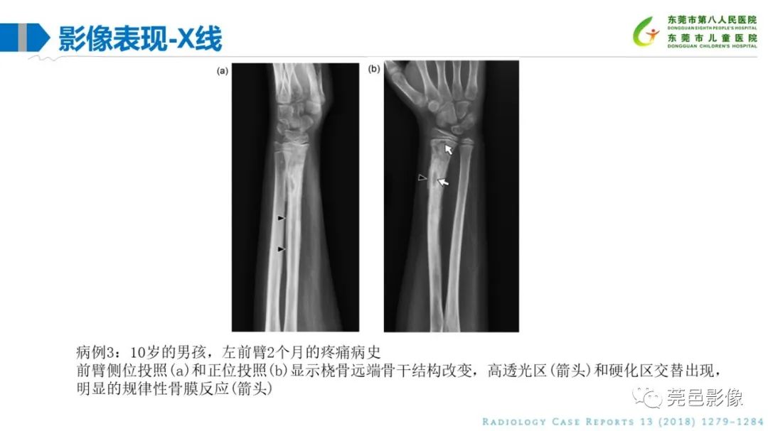 影像PPT - 【PPT】儿童骨淋巴瘤的影像表现-19