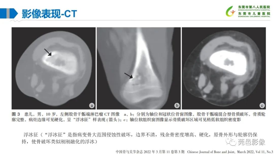 影像PPT - 【PPT】儿童骨淋巴瘤的影像表现-21