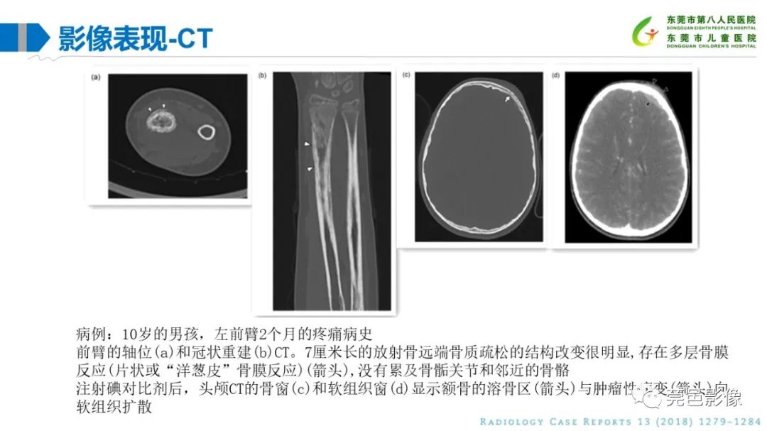 影像PPT - 【PPT】儿童骨淋巴瘤的影像表现-22