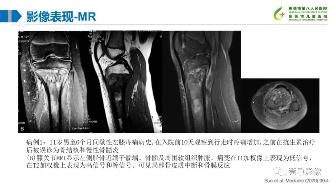 影像PPT - 【PPT】儿童骨淋巴瘤的影像表现-24