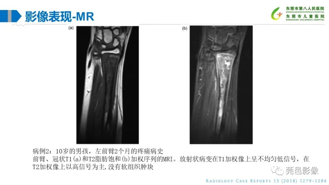影像PPT - 【PPT】儿童骨淋巴瘤的影像表现-25