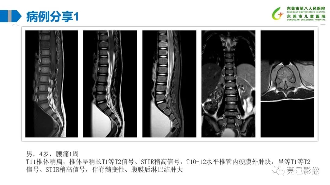 影像PPT - 【PPT】儿童骨淋巴瘤的影像表现-27
