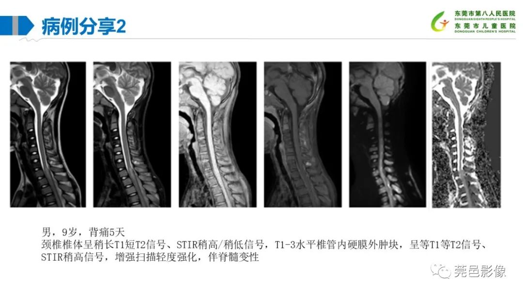 影像PPT - 【PPT】儿童骨淋巴瘤的影像表现-29
