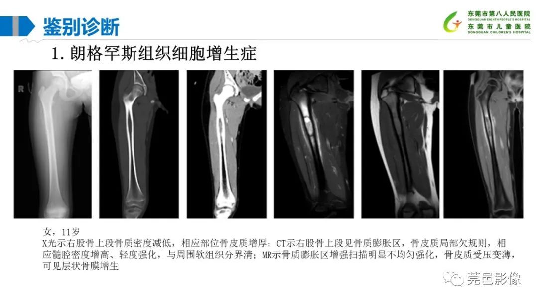 影像PPT - 【PPT】儿童骨淋巴瘤的影像表现-33