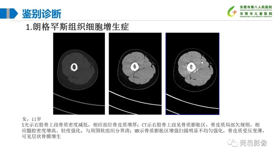 影像PPT - 【PPT】儿童骨淋巴瘤的影像表现-34