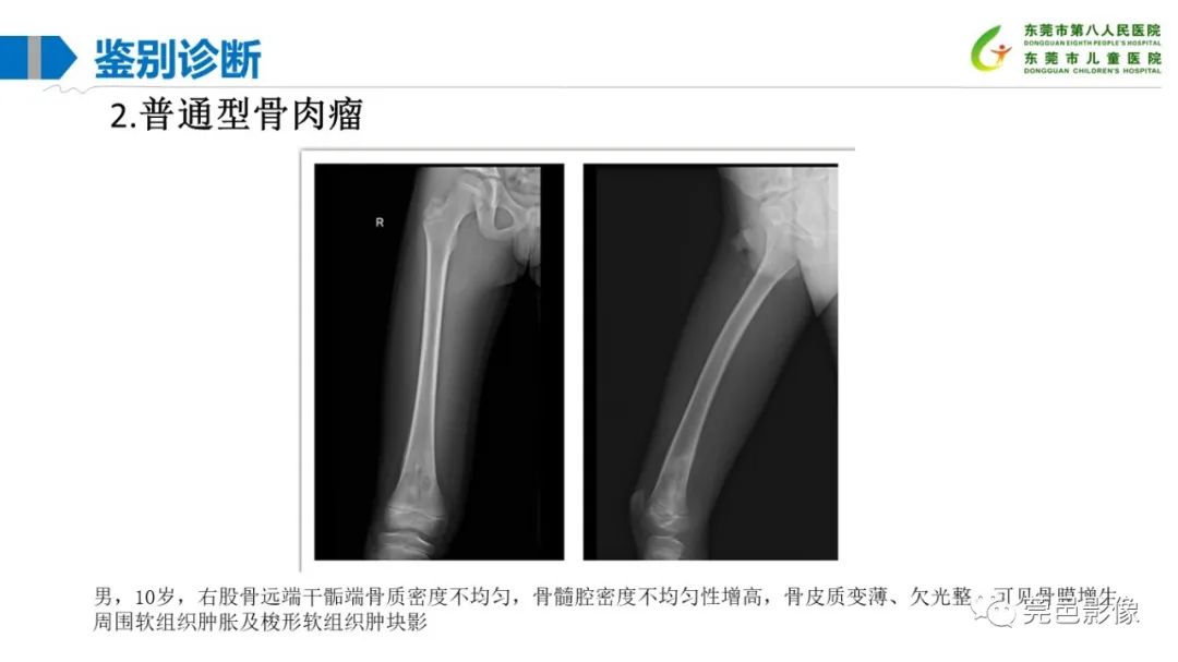 影像PPT - 【PPT】儿童骨淋巴瘤的影像表现-35