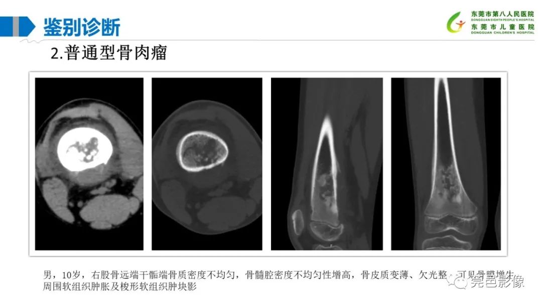 影像PPT - 【PPT】儿童骨淋巴瘤的影像表现-36