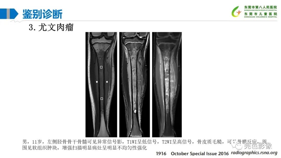 影像PPT - 【PPT】儿童骨淋巴瘤的影像表现-37