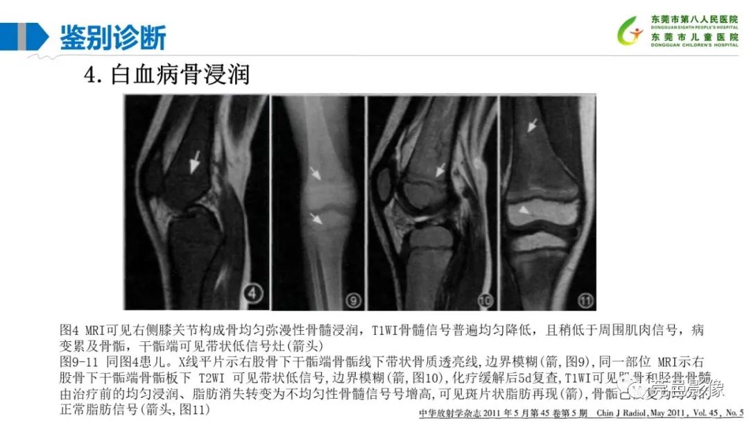 影像PPT - 【PPT】儿童骨淋巴瘤的影像表现-38