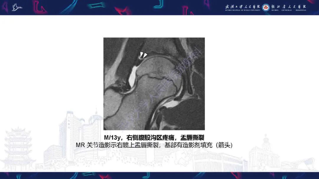 影像PPT - 【PPT】成人髋部疼痛MRI诊断-4