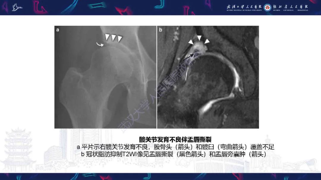影像PPT - 【PPT】成人髋部疼痛MRI诊断-5