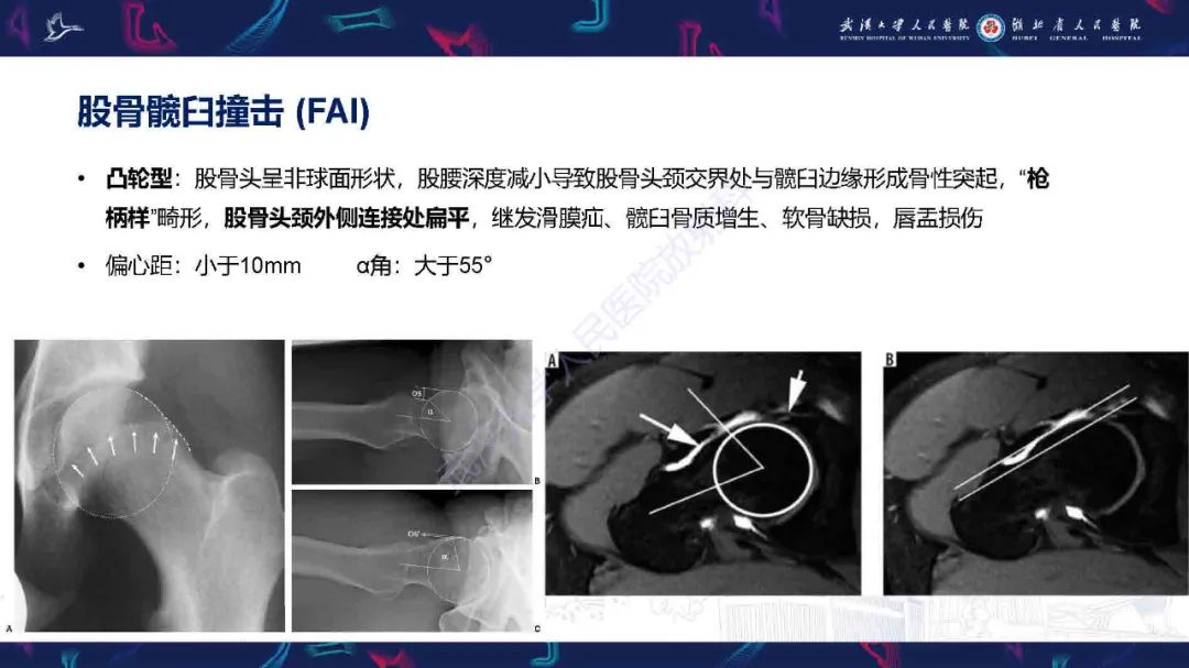 影像PPT - 【PPT】成人髋部疼痛MRI诊断-7