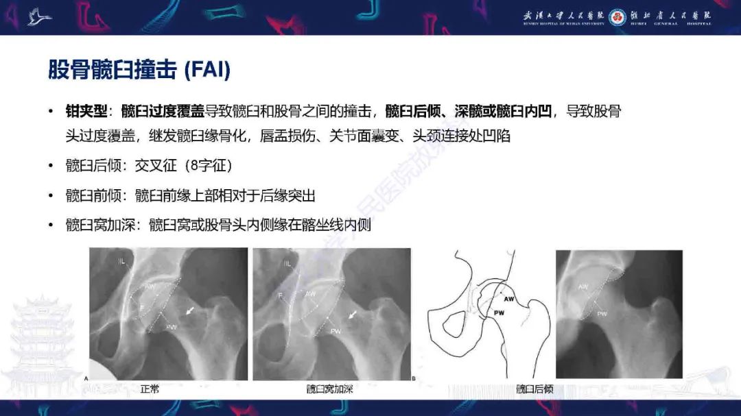 影像PPT - 【PPT】成人髋部疼痛MRI诊断-8