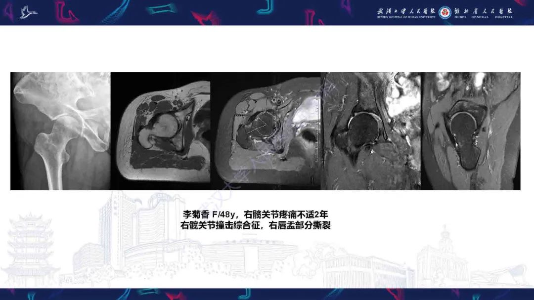 影像PPT - 【PPT】成人髋部疼痛MRI诊断-10