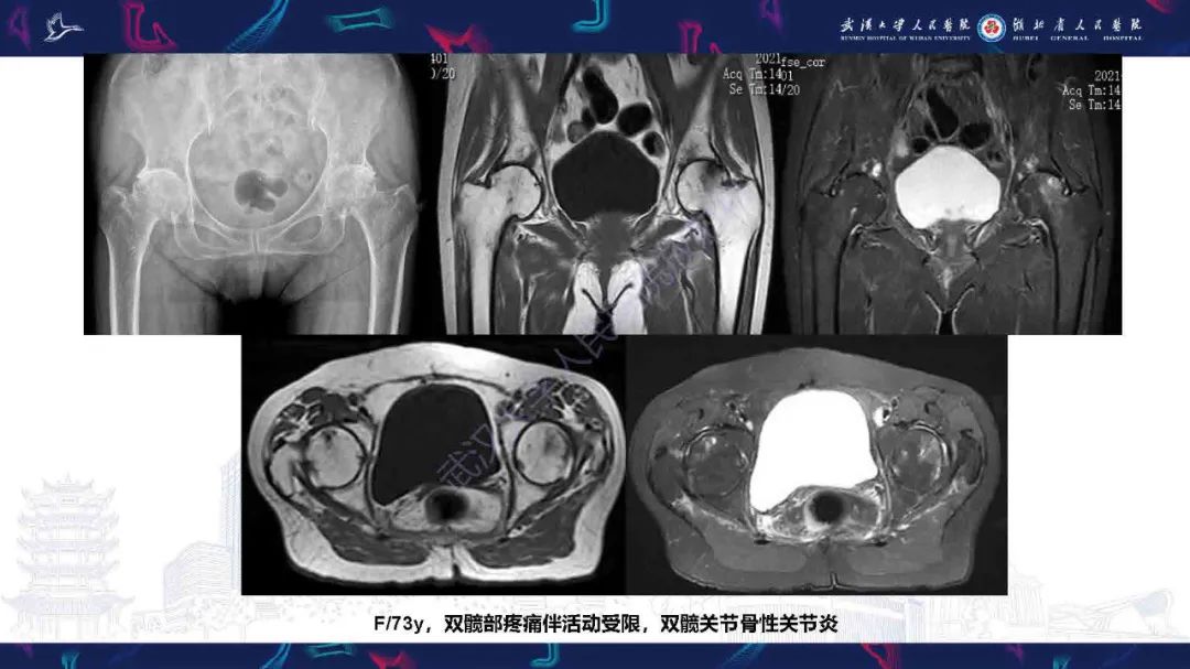 影像PPT - 【PPT】成人髋部疼痛MRI诊断-12